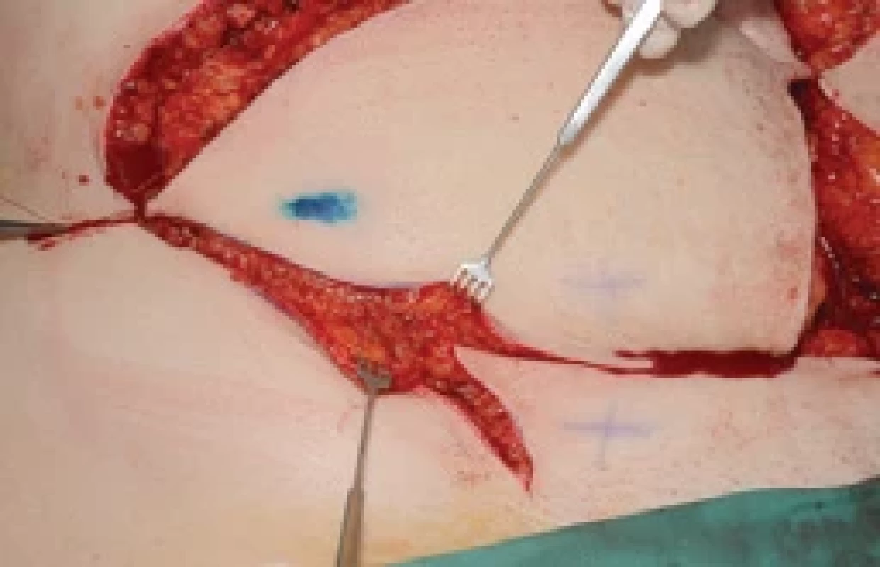 Bilateral profylactic skin sparing mastectomy and primary reconstruction with two DIEP fl aps. Right-sided DIEP fl ap enlarged with fat tissue containing three lymph node and then transferred on left hemithorax.