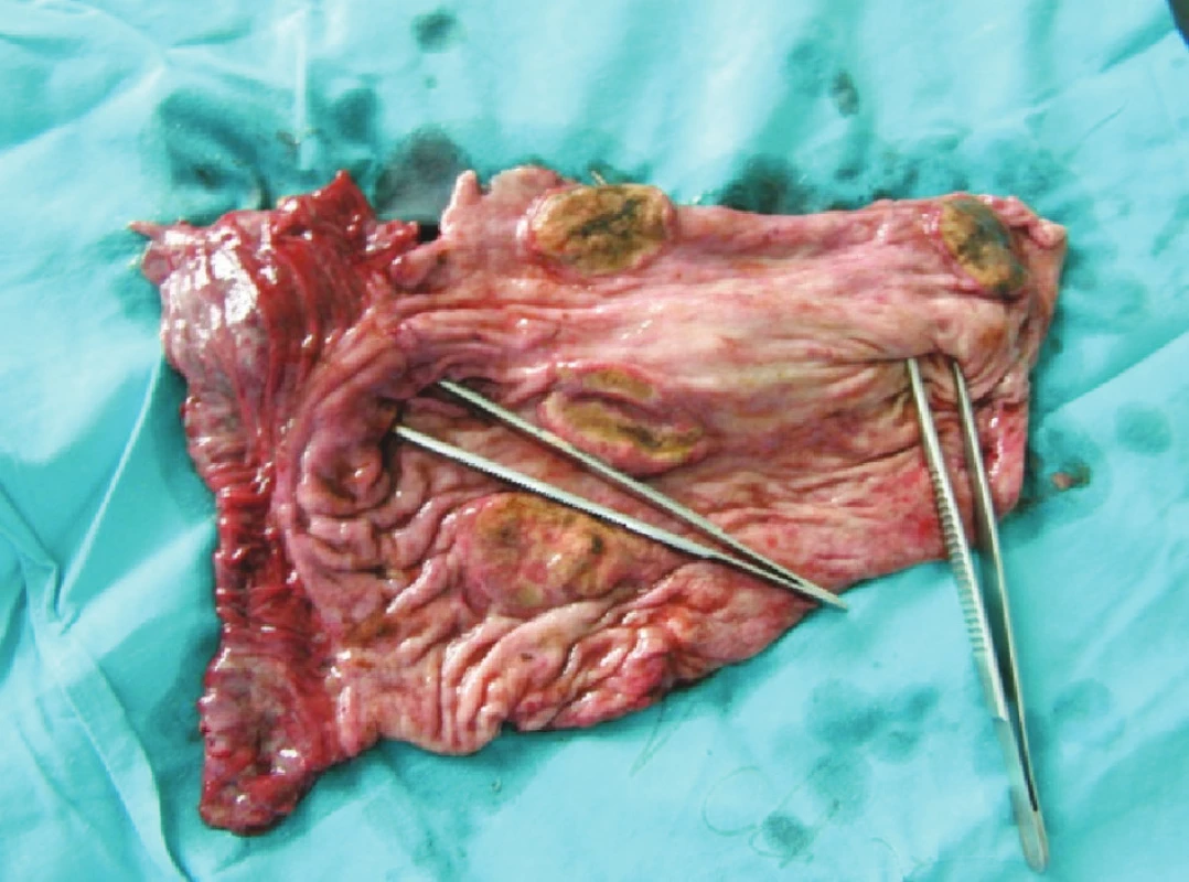 Exulcerácie žalúdka – zdroj krvácania (pinzety v kardii a pylore)
Fig. 3. Gastric exulcerations– sources of bleeding (pincers within the cardia and pylorus)