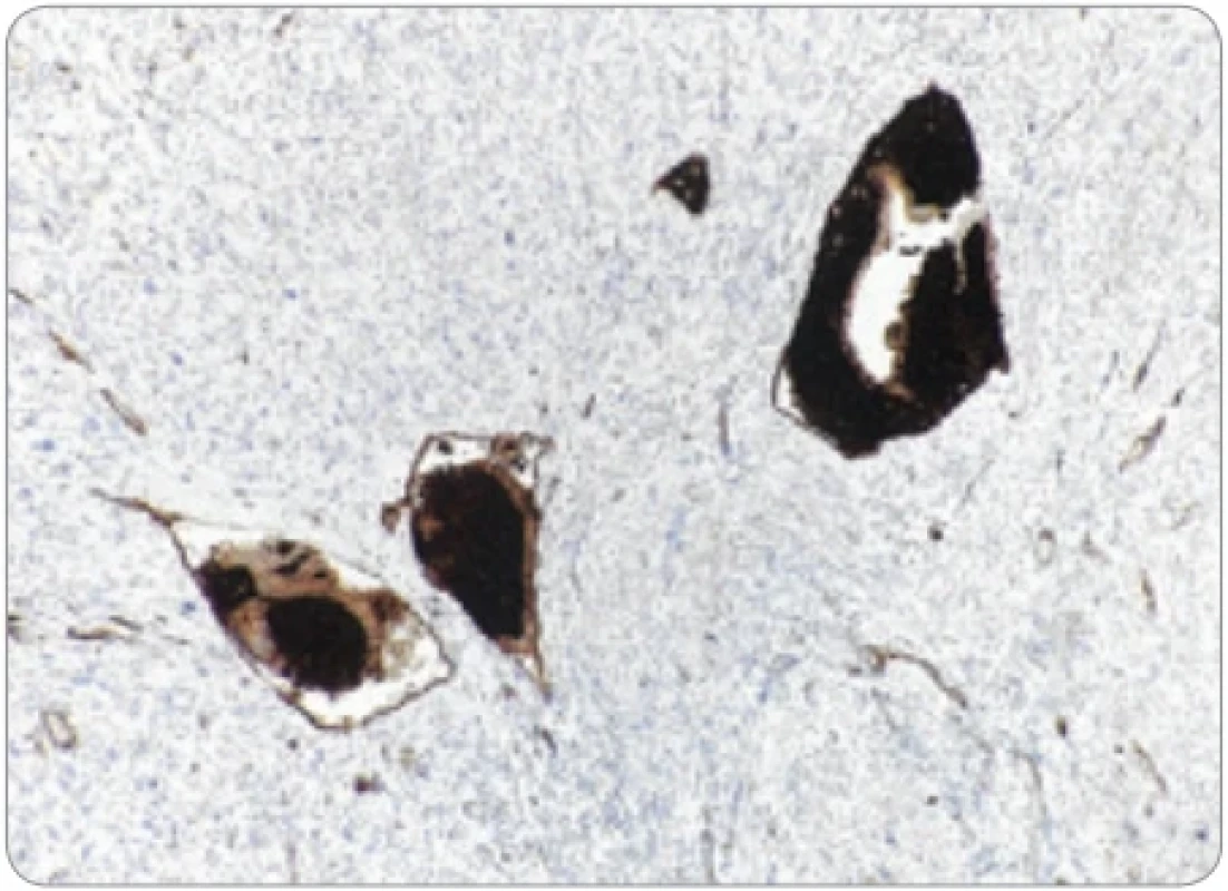 Imunohistochemická pozitivita endometriálnej strómy v cievach na CD10. (Zväčšenie 200×).