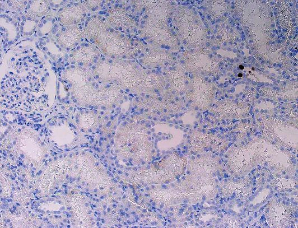 Polyomavirová nefropatie, imunohistochemický průkaz zcela ojedinělých jader. Bez imunohistochemického průkazu lze velmi snadno infekci minout a dojít k mylnému diagnostickému závěru (objektiv 10x).