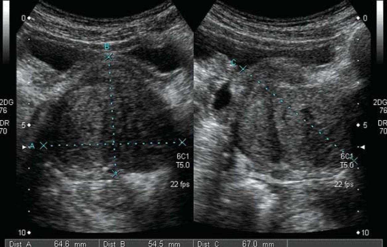 Benigní hyperplazie prostaty - transabdominální vyšetření.