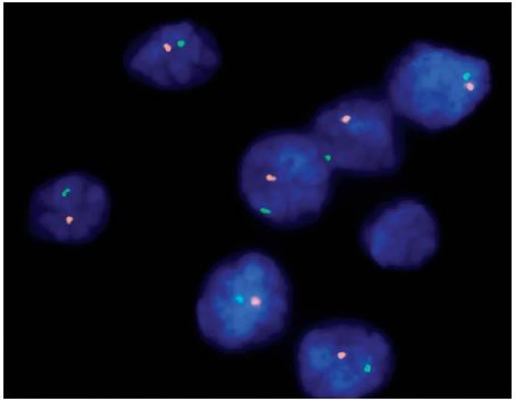 Fluorescenční in situ hybridizace (FISH) dokazující monosomii chromozomu 1 pomocí sond umístěných v lokusech 1p36 (oranžové signály) a 1q25 (zelené signály)
Fig. 2. Fluorescent in situ hybridization (FISH) proving loss of chromosome 1 using probes in loci 1p36 (orange signals) and 1q25 (green signals)