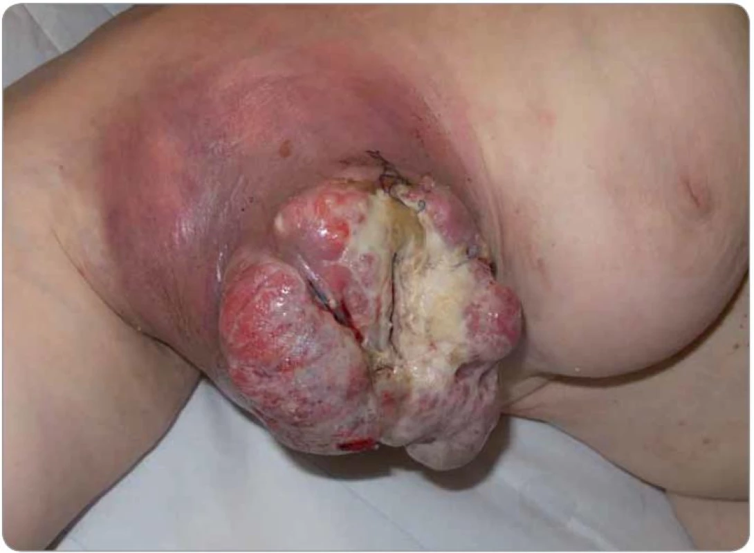 Axilla s protrudující metastázou melanomu před operací.