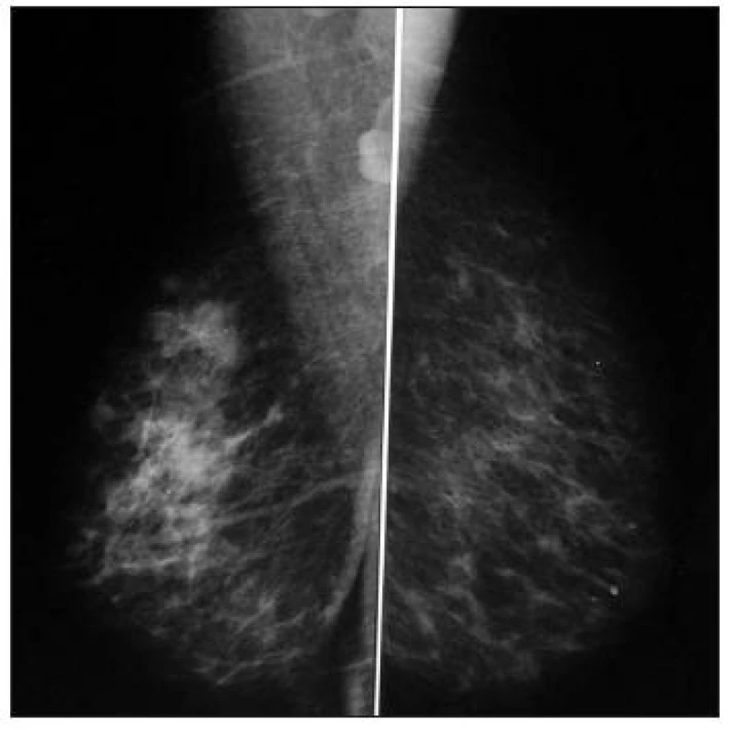 Mamografie pravého prsu
Fig. 2. Mamography of the right breast