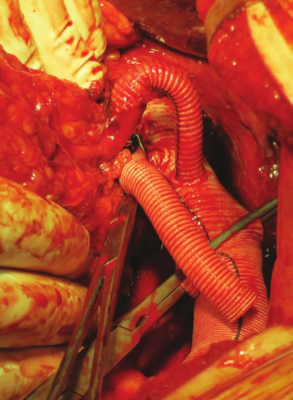Náhrada aorty od coeliackého trunku, bypass na levou renální tepnu
Fig. 15: Aorta replacement from coeliac trunk, bypass to left renal artery