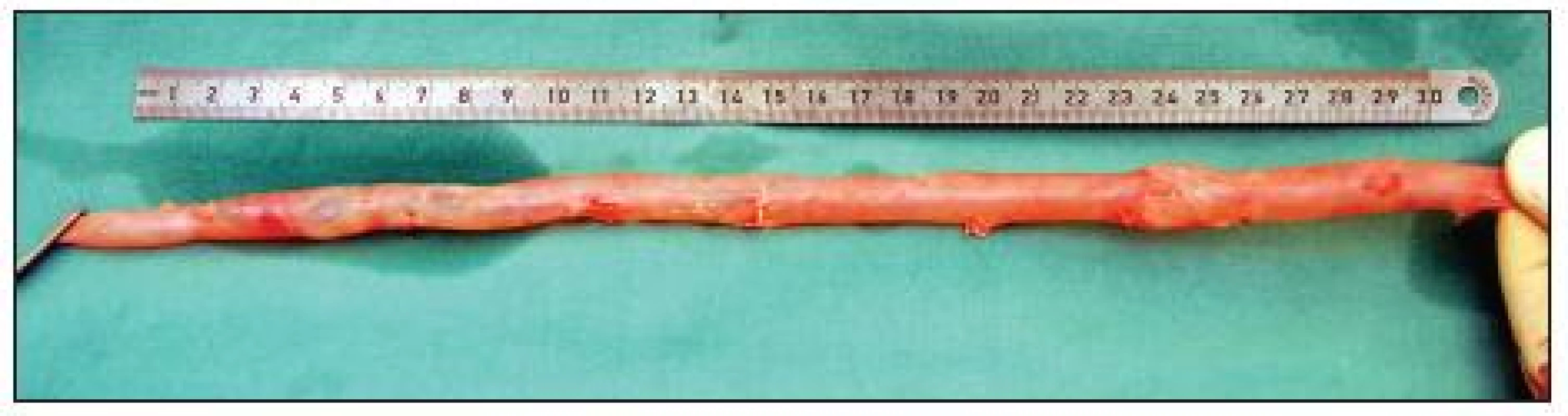 Odebraná femorální žíla v délce 33 cm připravená k použití jako štěp. Dostatečný průměr žíly na proximálním
i distálním konci vyhovuje plánované aorto-femorální rekonstrukci
Fig. 5. Harvested femoral vein, 33 cm in length, prepared for use as a graft. The vein diameter on both the proximal and the distal end is sufficient for the planned aorto-femoral reconstruction

