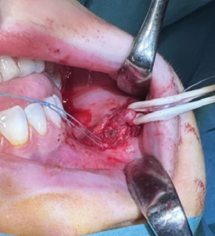 Dissected megaduct.