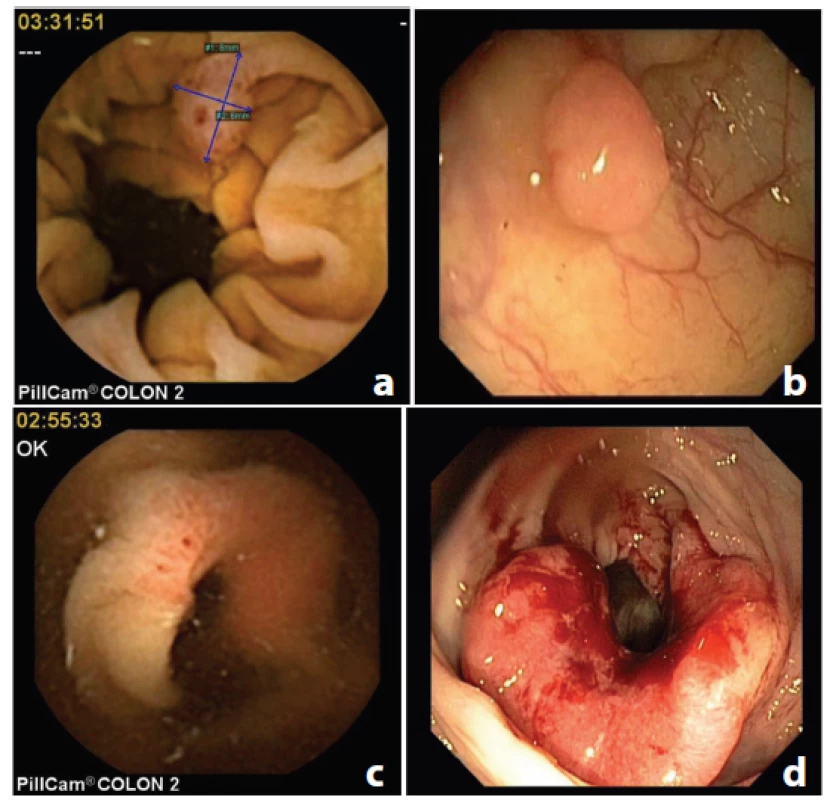 Porovnání lézí diagnostikovaných CCE a kolonoskopií (a: polyp, CCE; b: polyp, kolonoskopie; c: karcinom CCE; d: karcinom, kolonokoskopie); CCE = kapslová kolonoskopie
Fig. 3: Comparison of the lesions diagnosed with CCE and colonoscopy (a: polyp, CCE; b: polyp, colonoscopy; c: cancer, CCE2; d: cancer, colonoscopy); CCE = colon capsule endoscopy