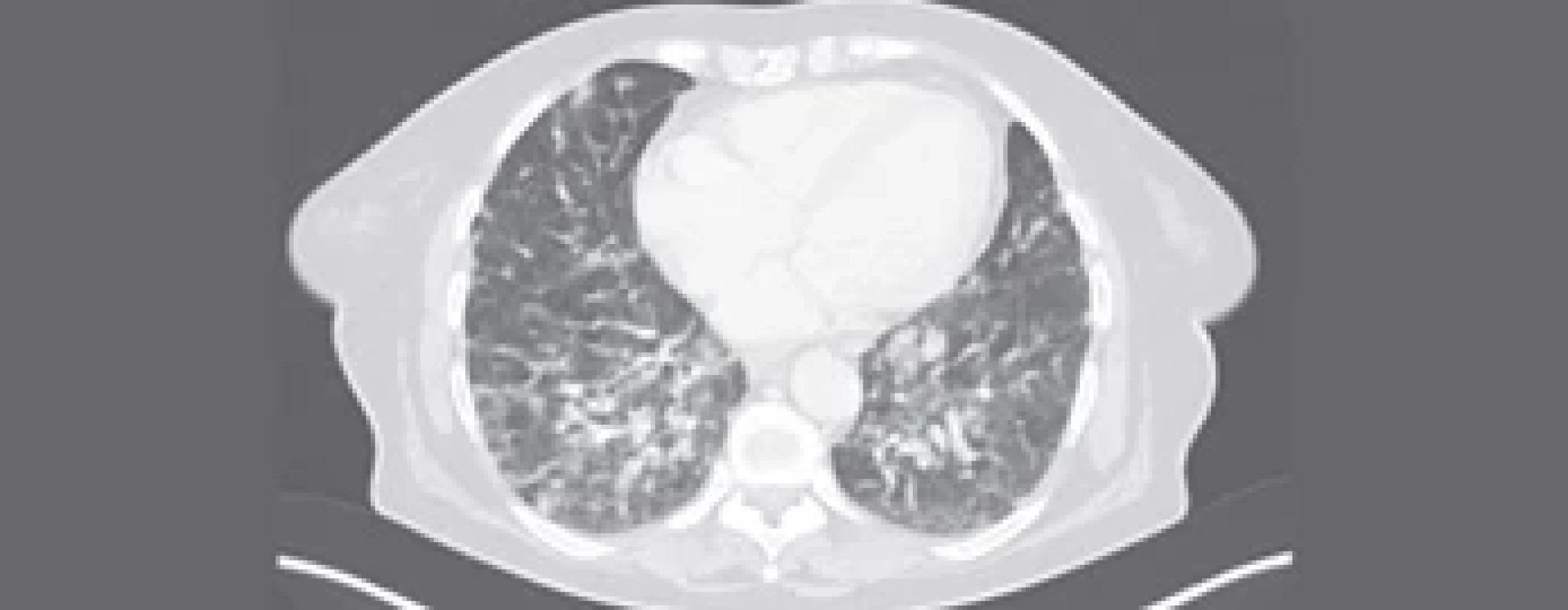 PET/CT. Zvýšená akumulace 18F-FDG ve vícečetných zvětšených LU nad i pod bránicí, v mnohočetných ložiscích obou plic i na pleuře, ojediněle v ložisku na peritoneu. Splenomegalie.
