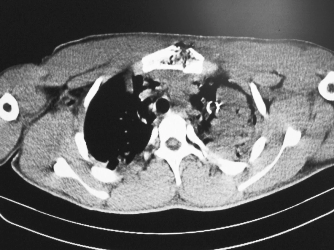 CT s nálezem těžké kontuze apexu levé plíce a zlomeninou sterna
Fig. 1. CT picture with serious contusion of apex of the left lung and sternal fracture