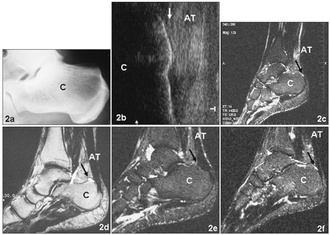 a. RTG snímek pravé patní kosti zdravého jedince (kazuistika a) v boční projekci
b. Ultrasonografie stejné paty téhož pacienta jako na obrázku 2a. Mírná plantární flexe. Šipka označuje oblast předpokládané zdravé RB
c. MR stejné oblasti téhož pacienta jako na obrázku 2b. Šipka označuje místo vyššího signálu v oblasti RB
d. MR paty pacienta s diagnózou retrokalkaneární burzitídy (kazuistika b). Šipka označuje prostor patologicky rozšířené burzy do tvaru frygické čapky
e. MR paty pacienta po chirurgickém odstranění RB (kazuistika c). Šipka označuje místo uložení původní burzy
f. MR paty pacienta 1 týden po distorzi hlezenního kloubu (kazuistika d). Vyšší signál v oblasti RB je označen šipkou
Fig. 2a. Lateral X-ray image of the right calcaneus of a healthy 36-year-old individual (cross country ski-marathon runner – case report a)
b. Ultrasonography of the heel region (in mild plantar flexion) of the same patient as in the Fig. 2a. The arrow designates the region of the healthy RB localization
c. MR image of the right foot of the same patient as in the Fig. 2a and 2b. The arrow designates a higher signal in the region of the RB
d. MR image of the 58-year-old patient suffering on the retrocalcaneal bursitis (case report b). The arrow designates the space of pathologically dilated RB in a shape of a Phrygi helmet
e. MR image of a 52-year-old patient (10 years after the surgical excision of RB for the diagnosis of chronical retrocalcaneal bursitis – case report c – cross country and marathon runner). The arrow designates the point of the originally placed RB
f. MR image of a 23-year-old patient (one week after the ankle joint distorsion – case report d – non sporting medical student). The arrow designates a higher signal in the region of normal RB