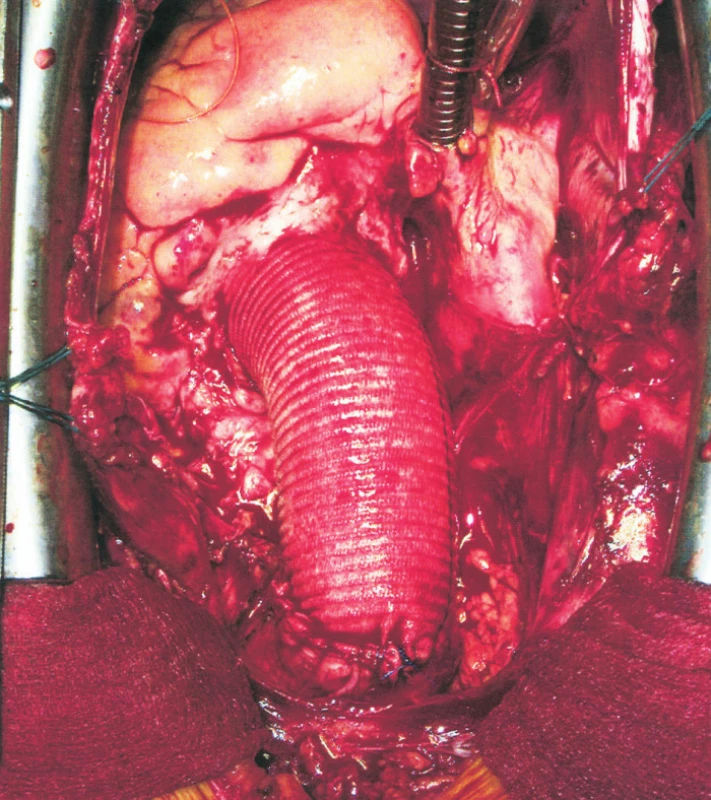 Vzestupná aorta nahrazena cévní protézou
Fig. 3. The ascendidng aorta, replaced with a vascular prosthesis