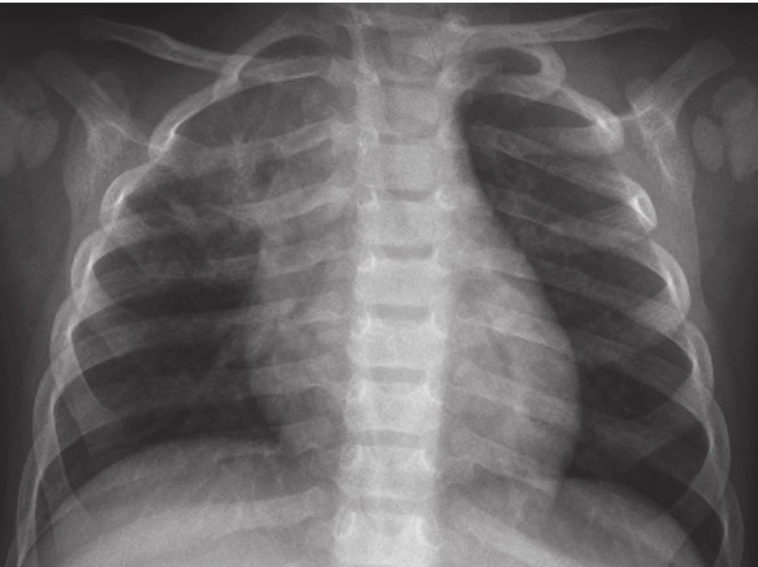 RTG snímek plic po 16 týdnech antituberkulózní terapie.
Fig. 4. Chest X-ray of infant after 16 weeks of treatment.