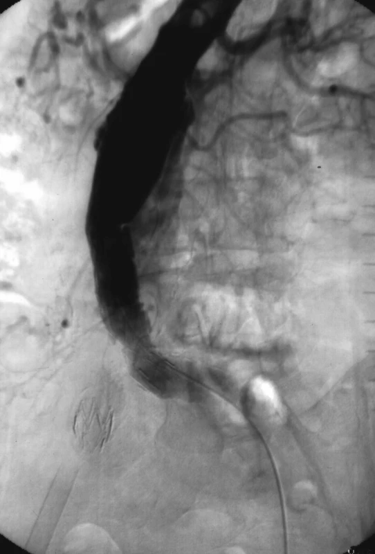2. Angiografie s průkazem proximálního perigraft leaku (endoleak typu Ia), který byl řešen přestentováním proximálního krčku dalším stentgraftem
Fig. 2. Angiography with detection of proximal perigraft leak (endoleak Ia) that was resolved with overstenting of proximal neck using next stentgraft