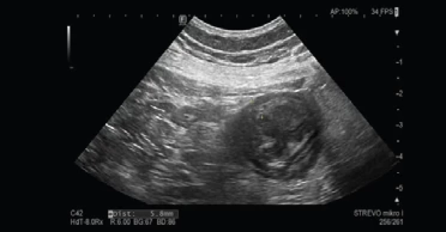 Sonografi cký obraz střeva v oblasti příčného tračníku se zesílením střevní stěny na 5,8 mm.