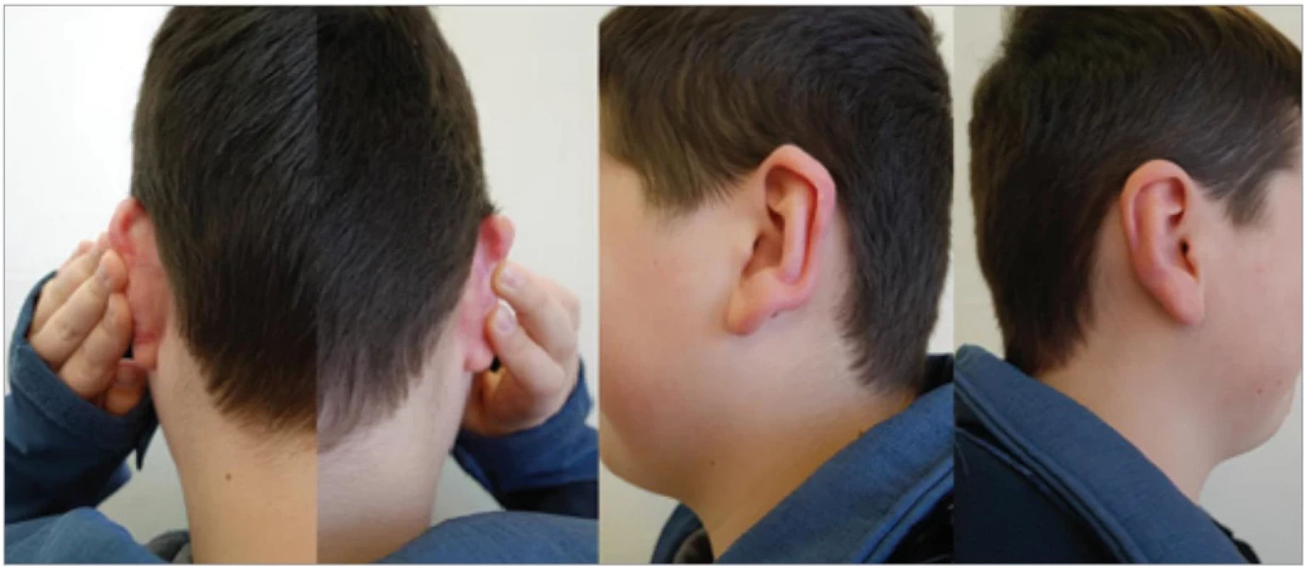  Patient 2 –outcome of scar maturation one year following keloid excision with consistent adherence to the treatment protocol (repeated intralesional corticosteroid administration, low-level laser therapy, regular application of silicone products, and pressure massage).