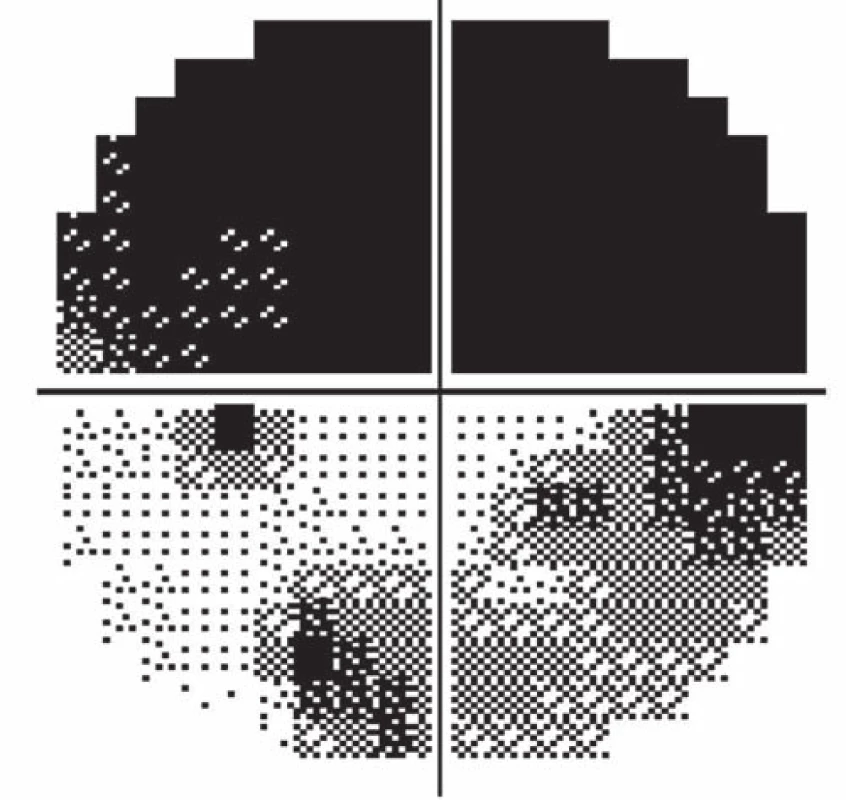 Improvement of visual fields after decompression of optic nerve sheaths.