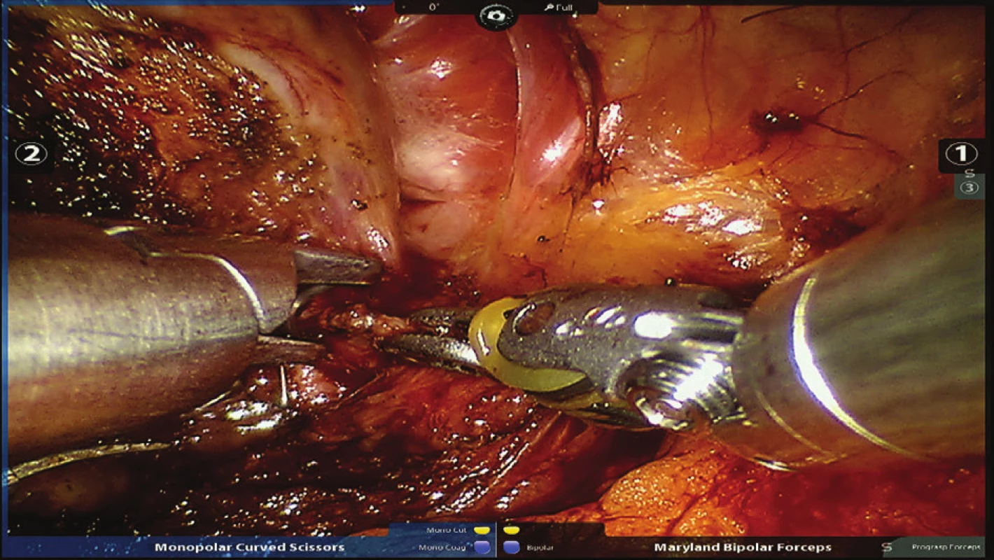 Nasazení titanového klipu na pravý pedikl
Fig. 5: Clipping of the right pedicle with a titanium clip