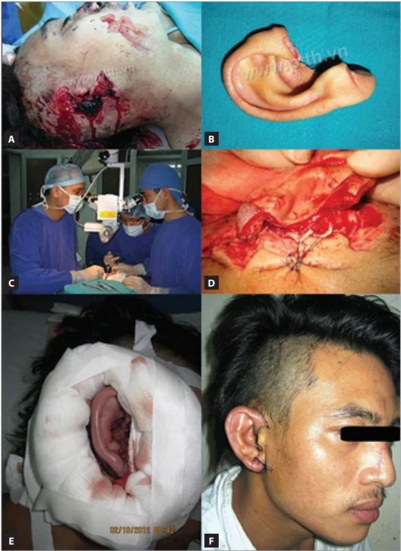  The fi rst total auricular replantation in Vietnam. (A,B) A 30-year-old male, total amputation of the right ear; (C) microsurgery; (D) after vascular dissection, the cartilages were left separated, providing a clear anterior view. The artery and vein were then anastomosed (diameter 0.4 mm); (E) 100% survival of the ear without any complications after surgery; (F) one week postoperative result.