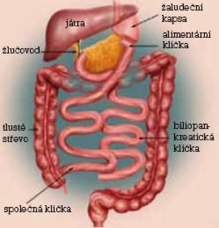 Biliopankreatická diverze.