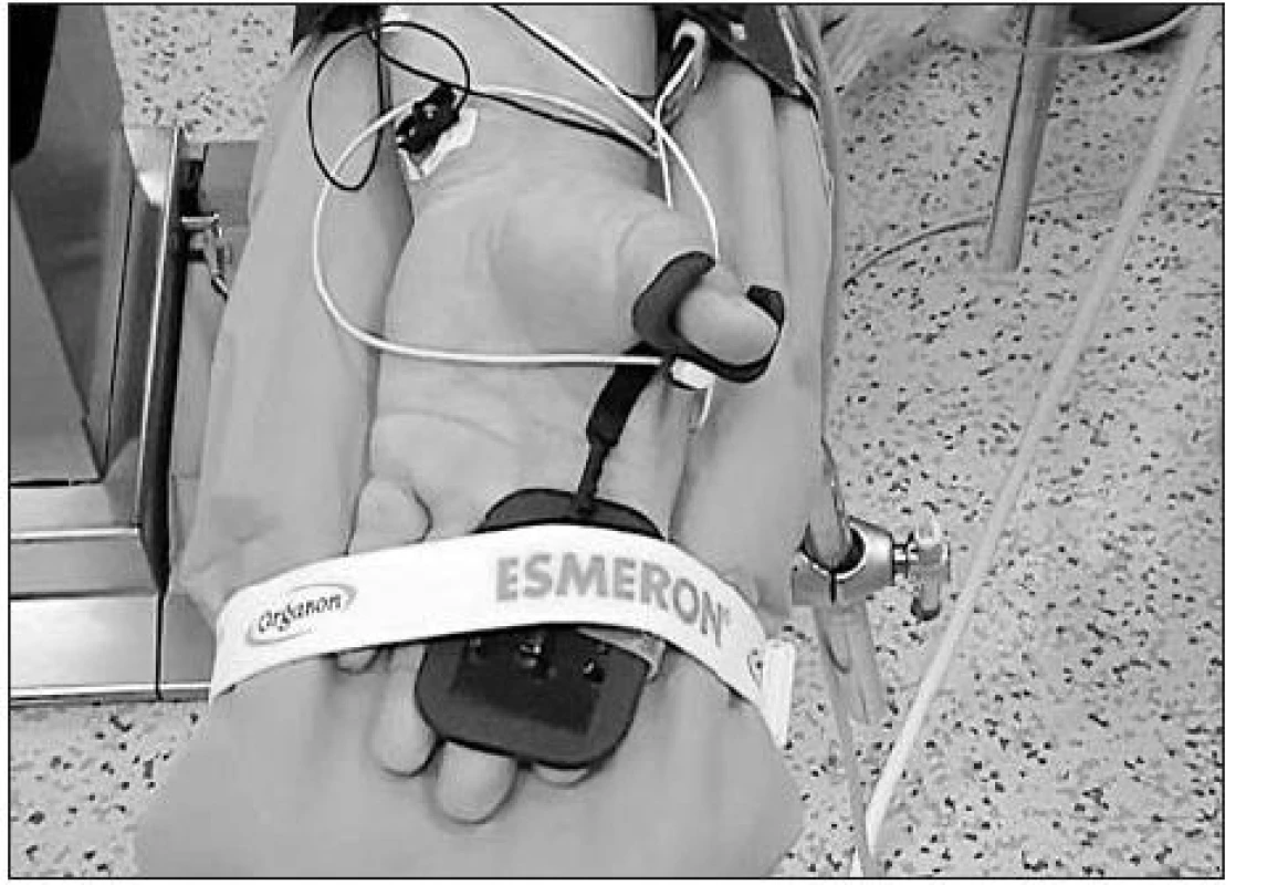 Akcelerometrie – přístroj TOF Watch® SX (Organon®) – uložení elektrod a akcelerometrického čidla