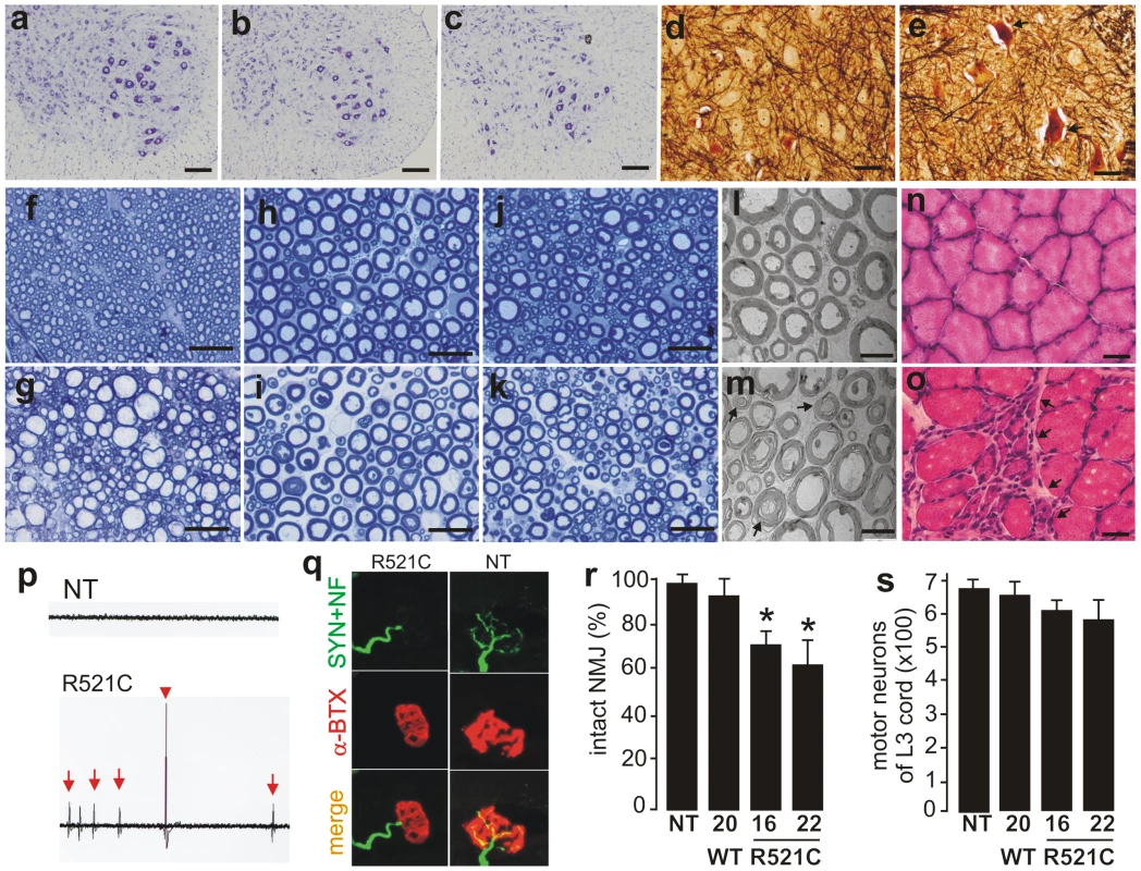 Motor neuron degeneration accompanied by denervation atrophy of skeletal muscle.