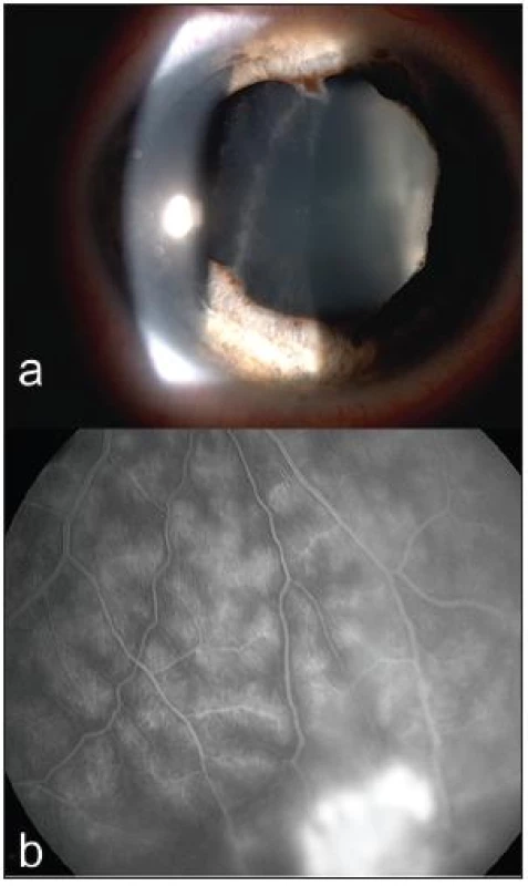 Panuveitida u pacientky s Crohnovou nemocí. Nález na předním segmentu se zadními synechiemi a buněčně zkaleným sklivcem (a). Fluorescenční angiografie okluzivní vaskulitidy s hyperfluorescencí v místě neovaskularizací