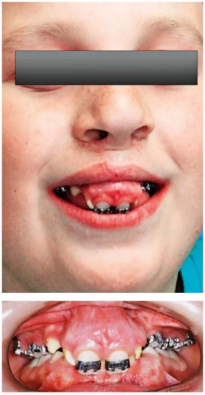 A, B. Face and teeth of the patient with fixed appliance before surgical repositioning of premaxilla