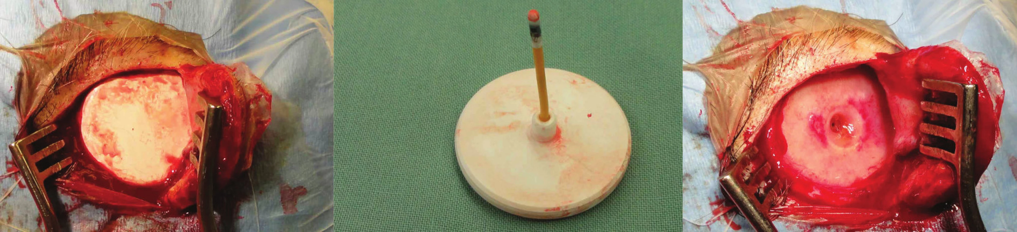 Extrakce telemetrického ICP čidla bez známek nepříznivé reakce na implantát
Fig. 4: Extraction of the telemetric ICP sensor with no signs of its side effects