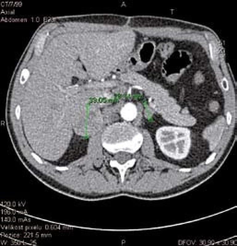 CT snímek zvětšených nadledvin.
Fig. 3. CT scan of enlarged adrenals.