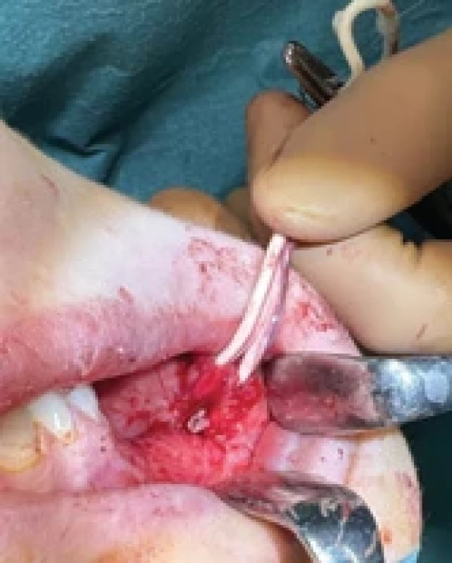 Stent sutured in place along with transposition of the Stensen’s duct.