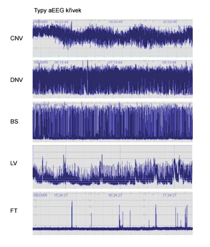 Typy aEEG křivek.CNV: normální křivka s minimální amplitudou 7– 10 μV a maximální 10– 25 μV,  DNV: mírně abnormální křivka s minimální amplitudou pod 5 μV a maximální amplitudou nad 10 μV, patologický záznam s minimální amplitudou pod 5 μV a maximální nedosahující 10 μV, křivka BS: „výboj- oploštění“, LV: nízkovoltážní křivka, FT: plochá křivka.