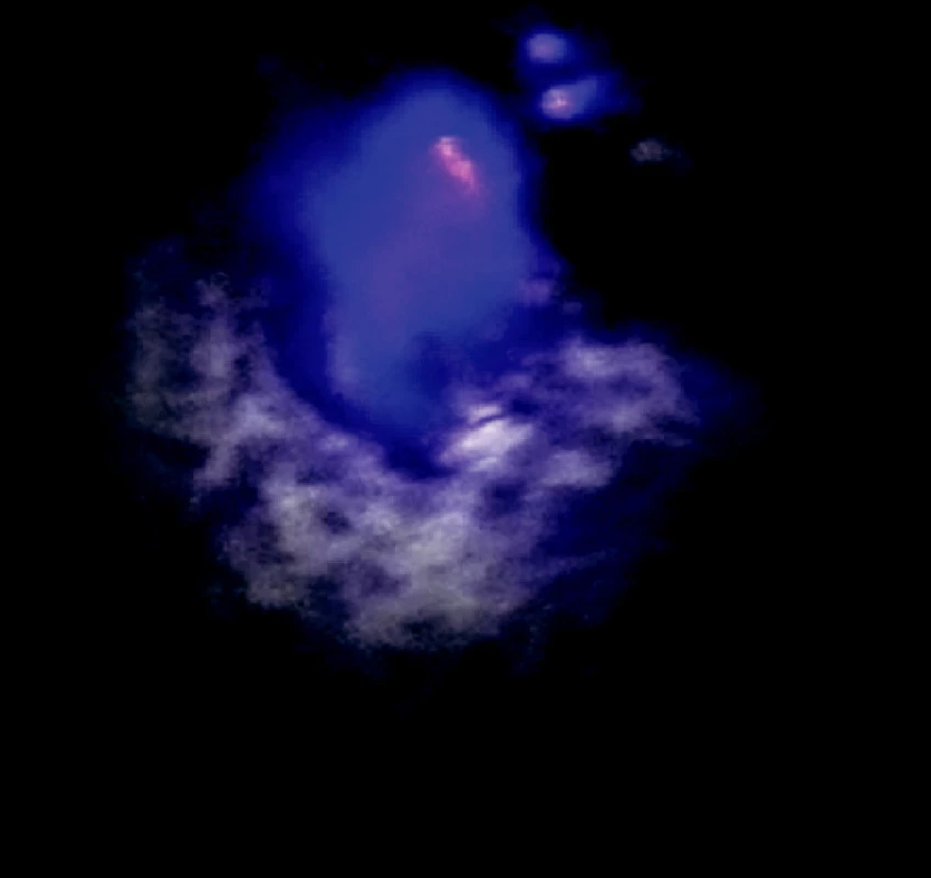 Ložisko adenokarcinómu na viscerálnej pleure v autofluorescenčnom obraze
Fig. 8. An autofluorescence view of the visceral pleura adenocarcinoma focus