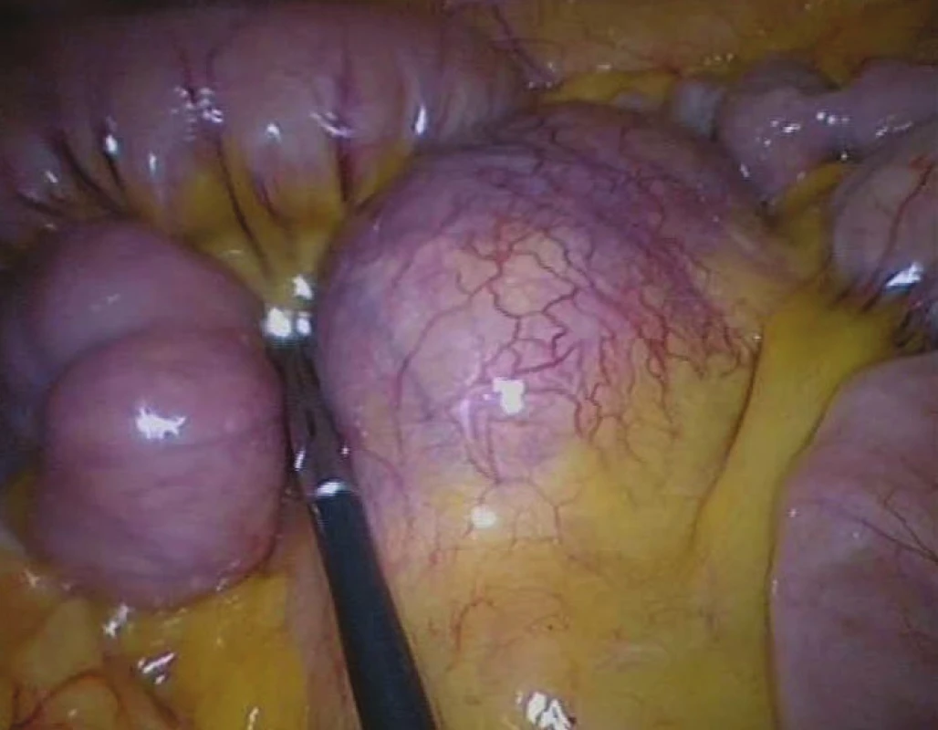 Nádor mezenteria s bohatou vaskularizací
Fig. 4: Mesenteric tumour with rich vascularization