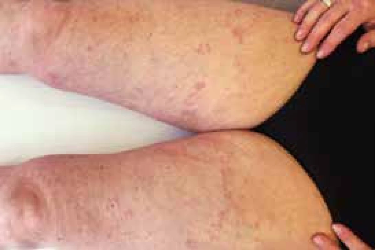 Necrobiosis lipoidica