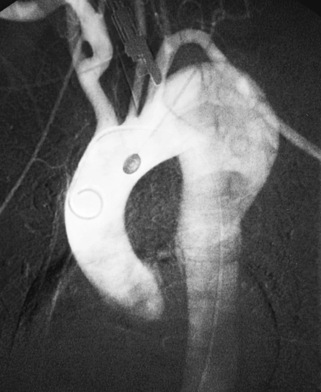 DSA obraz aneuryzmatické dilatace disekované hrudní aorty
Pic. 6. A DSA view of aneurysmal dilation of the dissected thoracic aorta