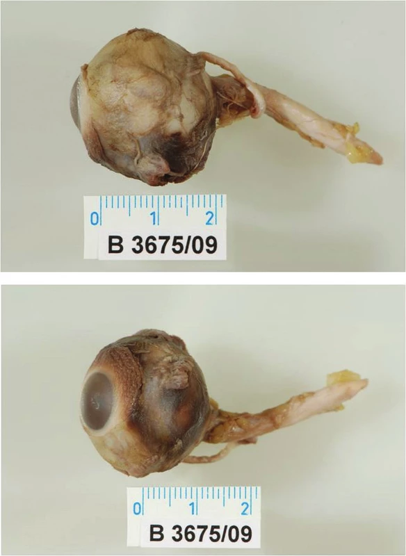 Neporušené enukleované levé oko s enormně dlouhým pahýlem zrakového nervu (4,5 cm), s odtrženými zevními očními svaly
