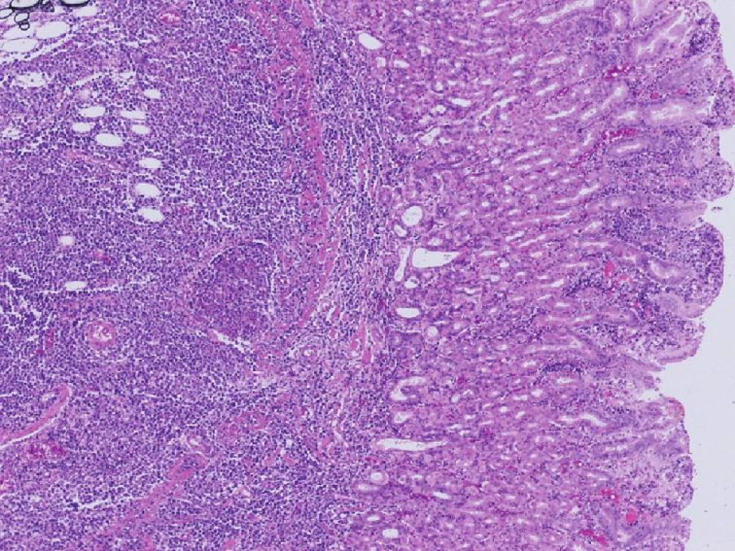 Histologický obraz B-NHL v resekáte žalúdka
Fig. 6. Histological finding of B-NHL in the gastric resecate
