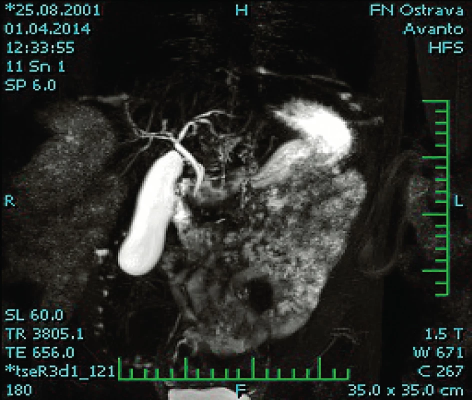 MRCP s obrazem mnohočetných stenóz ductus hepaticus communis, ductus hepaticus dexter a sinister a jejich větví.
Fig. 1. MRCP with multiple stenoses ductus hepaticus communis, ductus hepaticus dexter et sinister and their branches.