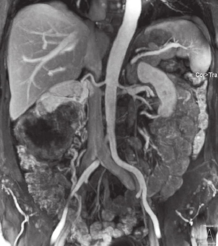Žena s objemným tumorem vycházejícím z dolního pólu pravé ledviny s generalizací. Před cytoredukční nefrektomií provedena MRA. 2A – ukazuje arteriální fázi, 2B – venózní, při které je mj. dobře patrná mohutná drenáž z tumoru do ovarické žíly
Fig. 2. Woman with large tumour of the lower part of the right kidney T3aN0M1. 2A – arterial phase, 2B – venous phase (aberrant veins from tumour to the ovaric vein are clearly visible)