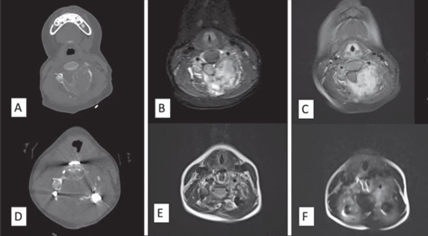 Images of the osteoblastoma patient who underwent instrumentation (Patient 18): (A) preoperative axial CT image; (B) preoperative axial T2-weighted MRI image; (C) preoperative axial postcontrast T1-weighted MRI image; (D) postoperative axial CT image; (E) postoperative axial T2-weighted MRI image; (F) postoperative axial postcontrast T1-weighted MRI image.