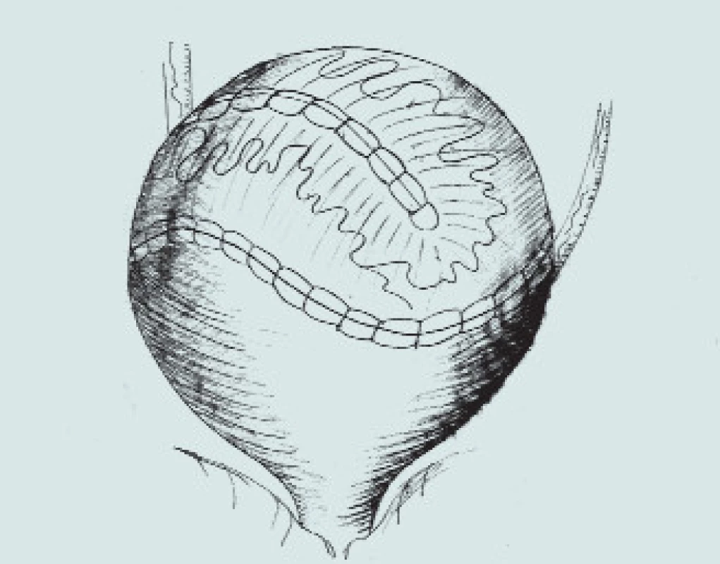 Ureterální augmentace.
(A – podélná incize hydroureteru a m.m., B – vložení vytvořené záplaty do rozpolceného m.m., C – vytvoření kupole m.m.)