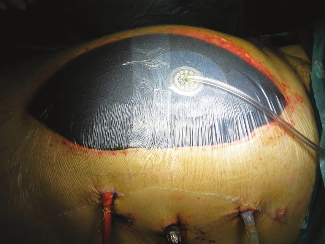 Použitie intraabdominálneho VAC metódou otvoreného brucha
Fig. 1. Use of Intraabdominal VAC, open abdominal surgery