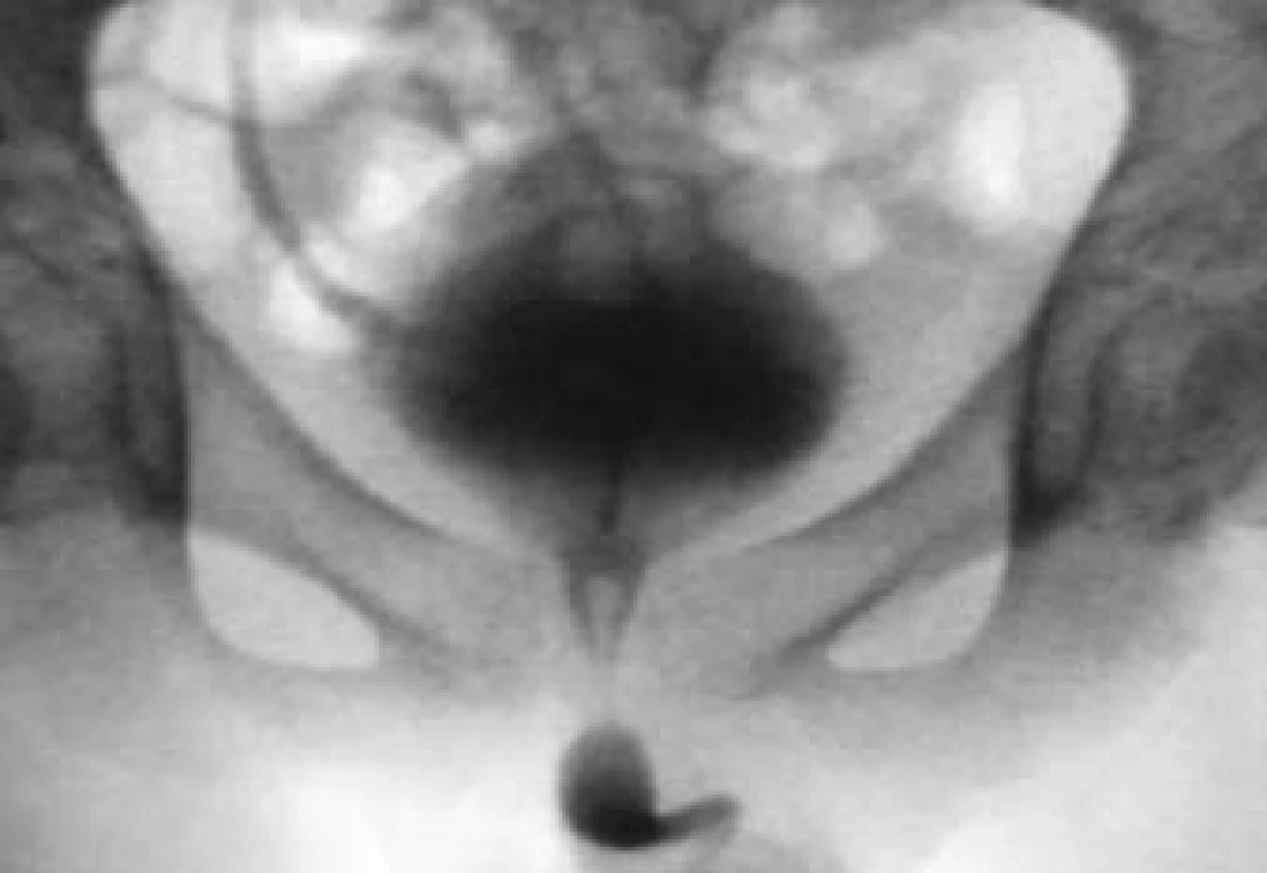 Hyperaktivní neurogenní detruzor o vysokém tlaku s dyssynergií sfinkteru detruzoru a refluxem pravého močovodu.