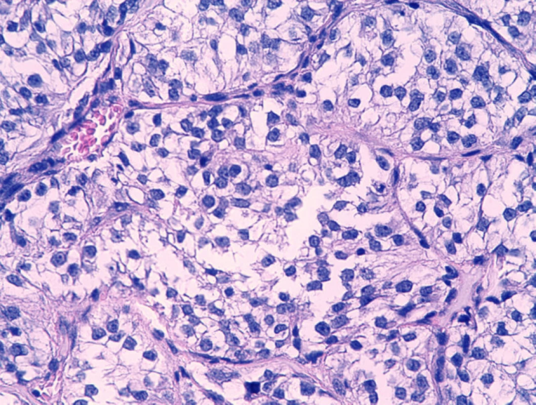 Histologický obraz kožnej metastázy – detail (hematoxylín-eozín, 400x).