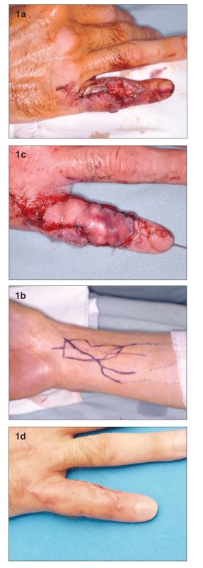 a. Defect with exposure of the proximal interphalangeal joint and loss of extensor tendon
b. Design of the venous flap on the distal forearm
c. Venous flap 2nd day post-op. Please note the degree of hyperemia is higher on the inflow (distal) part of the flap
d. Flap completely healed 1 month post-op