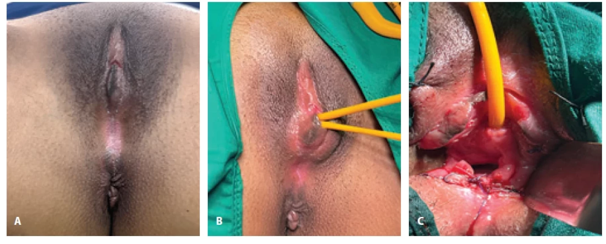 A) Patient with persistent urogenital sinus; B) post- cystoscopy catheterization of urinary and vaginal tracts; C) post-operative image after labial fl ap vaginoplasty.