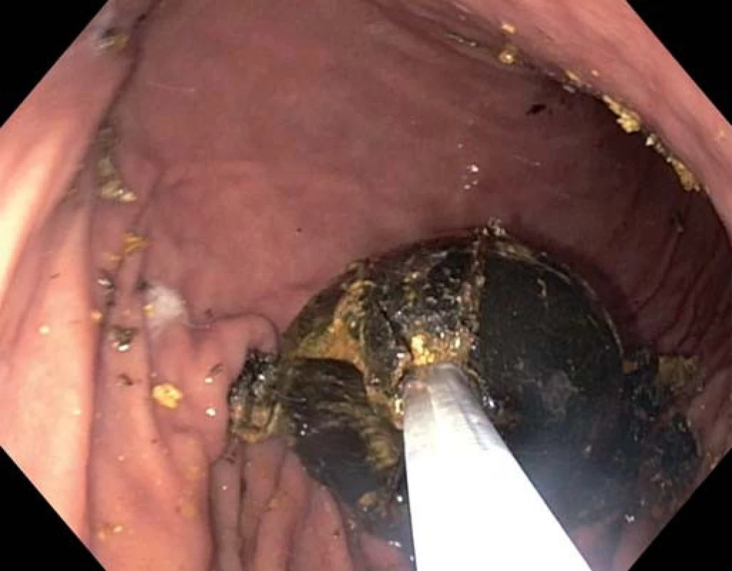 Objemný konkrement zachycený mechanickým litotryptorem.
Fig. 2. Large gallstone in the lithotripsy basket.