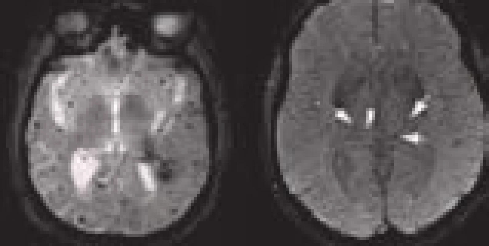 Mikrohemoragie jsou hypointenzní tečky o průměru 2–5 mm.
