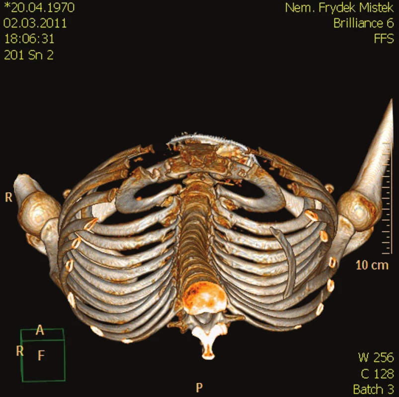CT- 3D rekonstrukce skeletu hrudníku zobrazující dislokaci zlomeného VIII. žebra vlevo
Fig. 4. CT- 3D reconstruction of the thoracic cage, depicting dislocation of the fractured 8th rib on the left side